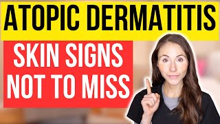 Dont Miss These 15 Signs Of Atopic Dermatitis [upl. by Kopans]