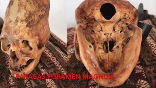 DNA Results Of The Paracas Elongated Skulls Of Peru Part 3 Physical Anomalies [upl. by Eenhpad]