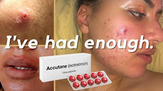 Why Im Starting Accutane Isotretinoin For My Cystic Acne 40mg Accutane Journey accutane acne [upl. by Hajan]