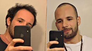 BALDING HAIR vs BUZZ CUT At 23  My Experience [upl. by Relyt]