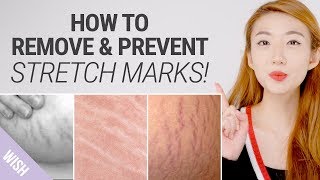 How To Get Rid of Stretch Marks Fast  Natural Remedies for Stretch Mark Removal  Whats TRENDing [upl. by Aldo109]