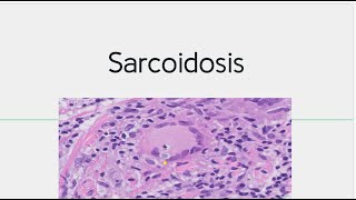 Sarcoidosis  Morphology Pathogenesis [upl. by Ecydnac]