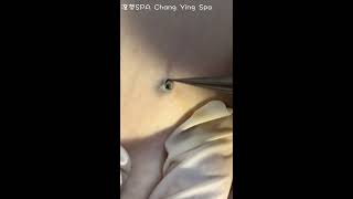 深層黑頭 Deep DPOW extraction  澄熒SPA [upl. by Adyela836]