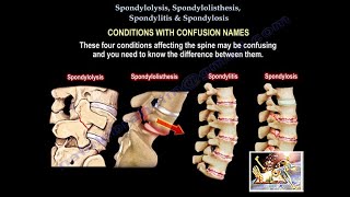 Spondylolysis Spondylolisthesis Spondylitis SpondylosisEverything Need To KnowDr Nabil Ebraheim [upl. by Stillmann]