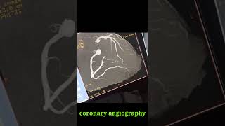 CT CORONARY ANGIOGRAPHY [upl. by Tamara]