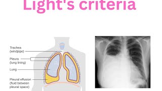 Pleura  Pleural effusion  Lights criteria  Transudate  Exudate Empyema [upl. by Sabir]