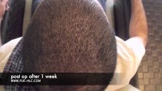 FUE Hair Transplant Hair Transplant Repair Hairline Clinic [upl. by Welford]