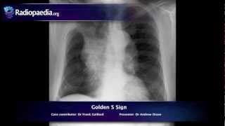 Golden S sign  radiology video tutorial xray [upl. by Cochrane]