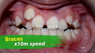 Braces 3 year  x10 milion speed [upl. by Edithe]