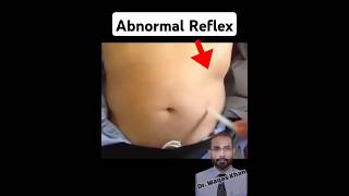 Asymmetrical Abdominal Reflex [upl. by Kaete]