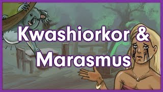 Kwashiorkor vs Marasmus  Nutrition Mnemonic [upl. by Soane]