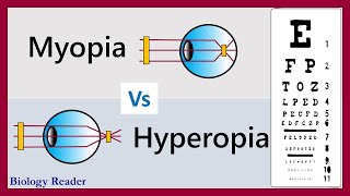 Difference Between Myopia and Hyperopia  Examples and Comparison Chart [upl. by Azriel]