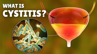 Cystitis – Causes Signs and Symptoms Diagnosis amp Treatment [upl. by Fritz714]