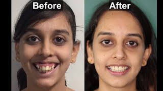 BRACES  before and after  BEST SMILE TRANSFORMATION  Gummy smile  smile design  mini implants [upl. by Ancell]