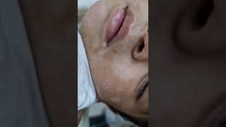 White spots on face in children  pitryiasis alba  home remedies and treatment  calcium deficiency [upl. by Anthony]