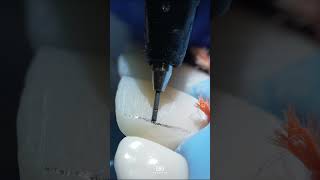 Mastering direct restoration of anterior teeth DentalEducation AnteriorRestoration [upl. by Margalit]