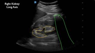 Ureterolithiasis at the Ureterovesical Junction UVJ with Twinkle Artifact [upl. by Etty]