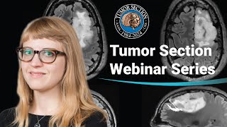 Latest highlights in Neurosurgical Oncology Epidemiology of Brain Tumors [upl. by Idyh]