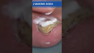 DIY Toenail Fungus Cures 3 Effective Home Remedies Unveiled shorts [upl. by Eissac]