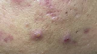 Relaxing With NaSa Da Nang Spa Beauty Blackheads Acne Extraction Date Nov142024 [upl. by Frentz511]