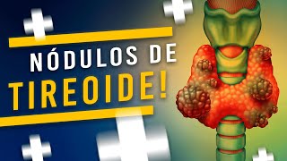 NÓDULOS NA TIREOIDE sintomas exames ultrassom e PAAF do nódulo na tireoide [upl. by Felton]