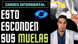 Te SORPRENDERÁ lo que ESCONDEN estas muelas  CARIES INTERDENTAL O INTERPROXIMALES [upl. by Asiluj]