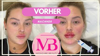 Aesthetic Day like theKARDASHIANS5KinnaufbauWangenaufbauLippenunterspritzung bei Medicare Beauty [upl. by Sternlight218]