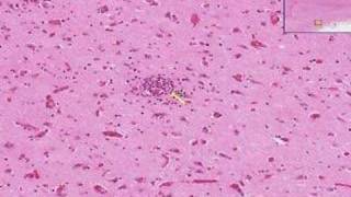 Histopathology Brain Viral encephalitis [upl. by Carla516]