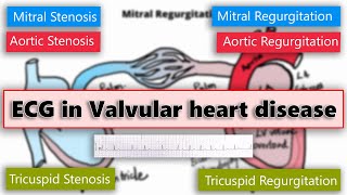 ECG changes in Valvular heart disease [upl. by Andri]