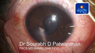 A long intraocular foreign body Dr Sourabh Patwardhan [upl. by Nic]