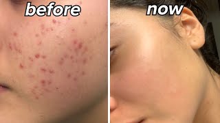 HOW I CLEARED MY SKIN my acne journey [upl. by Nnylassej631]