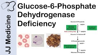 Glucose6Phosphate Dehydrogenase Deficiency  Symptoms Pathophysiology Diagnosis and Treatment [upl. by Ishmul]