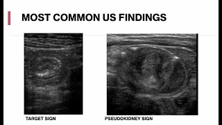 Pediatric Abdominal Ultrasound  Appendicitis Intussusception Mesenteric Adenitis [upl. by Aidualk552]