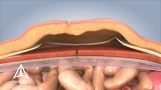 Ventral Hernia Repair  3D Medical Animation [upl. by Bobette477]