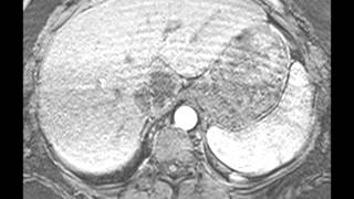 Hemangioma [upl. by Adnolor]