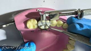 Class ll Amalgam Restoration  in Lower 6  Dr Rawan Medhat  شرح بالعربي [upl. by Oetam]