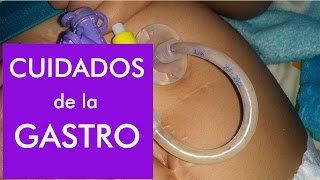 Gastrostomía  Lavado de sonda y como evitar taponamientos [upl. by Aip643]