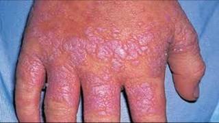 How To Treat And Cure Lichen Planus [upl. by Jezreel780]