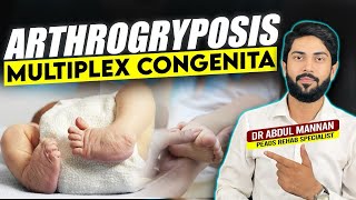 Understanding Arthrogryposis Multiplex Congenita Causes Symptoms and Treatment Options [upl. by Gnoy]