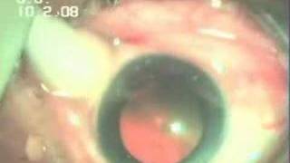 Intravitreal Injection Avastin In WET AMD Dr Sudhalkar [upl. by Eledoya]