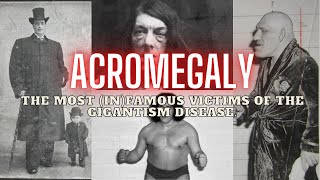 ACROMEGALY The Most InFamous Victims Of The Gigantism Disease  Full Pictures [upl. by Donahoe]