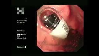 Capsule Endoscopy a helping hand [upl. by Tillman]