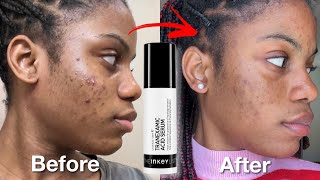 I Tried The Inkey List Tranexamic acid Serum For 1 Week  Before amp after Review  Results [upl. by Terrene]