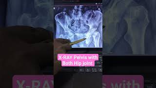 XRAY Pelvis with Both Hip Joint [upl. by Asela]