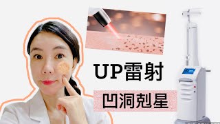 痘疤治療～到底 UP雷射 ultrapulse 是甚麼雷射呢？為甚麼是 凹洞剋星？你適合嗎？讓我們來拯救坑洞吧❤️❤️💪💪💪 [upl. by Myrna]