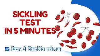 SICKLING TEST IN 5 MINUTES [upl. by Enalahs806]