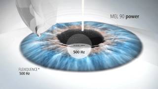 LASIK Laser Assisted In Situ Keratomileusis [upl. by Akiv]