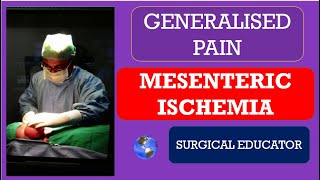 MESENTERIC ISCHEMIA How To DIAGNOSE amp TREAT GENERALISED ABDOMINAL PAIN [upl. by Aitnwahs776]