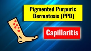 Pigmented purpuric dermatosis Capillaritis overview clinical features histology and management [upl. by Romona252]