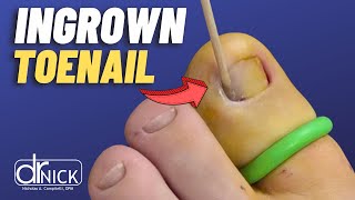 How to treat an ingrown toenail  Matrixectomy by Dr Campitelli [upl. by Volnay594]